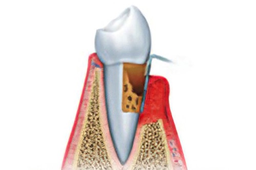 Cabinet dentaire Soumoulou Parodontologie