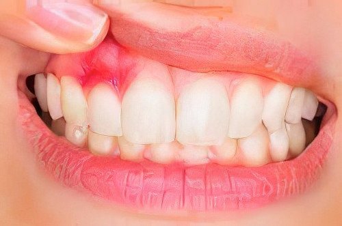 Chirurgie muco gingivale